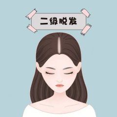 南京看脱发去哪个医院比较好