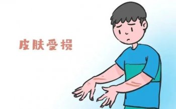 牛皮癣的早期症状