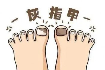 引起灰指甲的原因是哪些